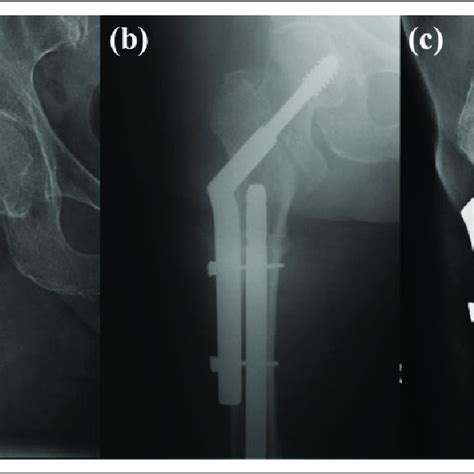 Case 6 Female 37 Subtrochanteric Peri Implant Fracture A Fixation