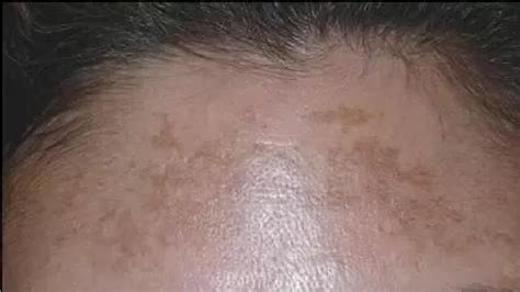 How To Get Rid Of Discoloration On Forehead Youtube