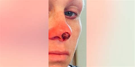 Diehard Tanner Left With Hole In Face After Skin Cancer Diagnosis