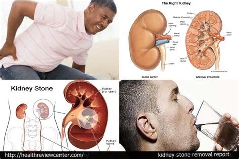 The most common home remedies for kidney stones involve drinking different fluids, including just water, to help flush your stones out and prevent new ones. Kidney Stone Home Remedy | How New "Kidney Stone Remedy ...