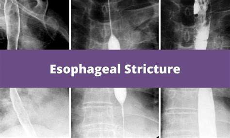 Esophageal Stricture Dilation