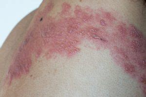 Chickenpox vaccine increases the risk of shingles in younger adults