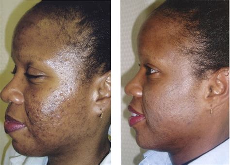 Professional Skincare Pigmentation Treatment Series Before And After