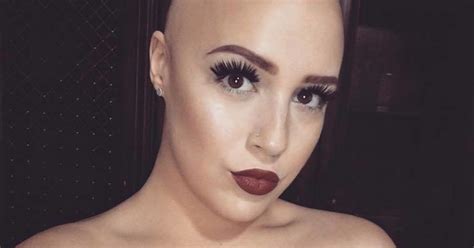 Woman With Alopecia Shares Inspiring Post About Feeling Beautiful Again