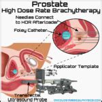 Prostate Brachytherapy Oncology Medical Physics