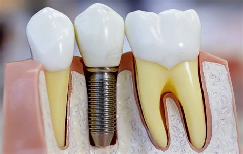 The Benefits Of Titanium Dental Implants Sensu
