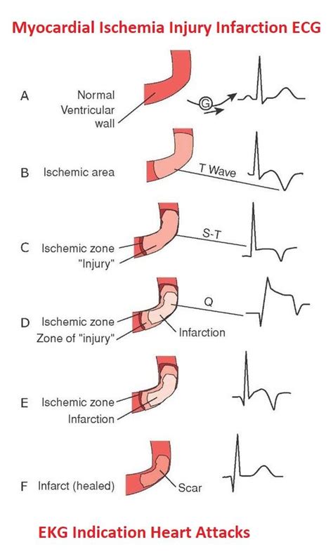 Myocardial Ischemia Injury Infarction Ecg Ekg Indication Heart Attacks