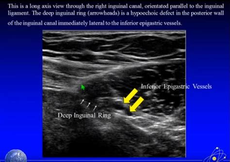 Direct And Indirect Hernia Inguinal Hernia Ahn Indirect Inguinal