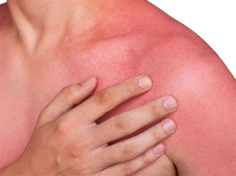 Medical News Today What Can Cause Red Skin Skin Redness Is Often