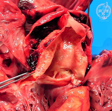 3cardiovascular System 10 Aortic Dissection Dissecting Aortic