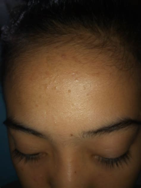 Pimples All Over My Forehead General Acne Discussion By Angeltrev