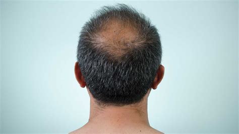 Scalp Conditions Pictures Causes And Treatments