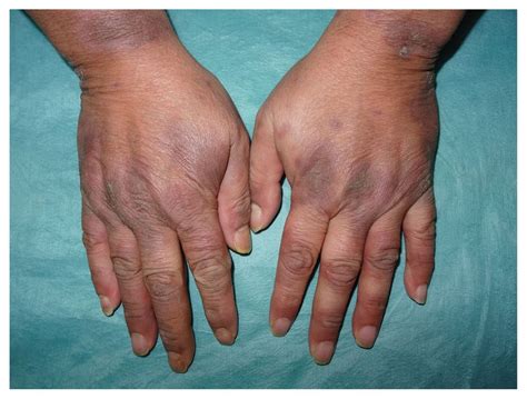 Rupioid Psoriasis On The Hands Cmaj