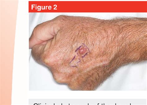 Figure 2 From Skin Cancer Of The Hand Current Concepts Semantic Scholar