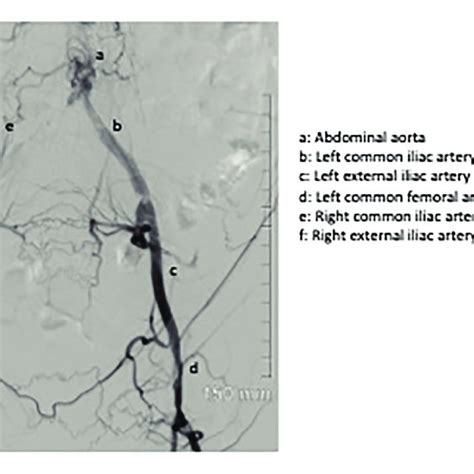 Diagnostic Angiogram Image Depicts Completely Occluded Right Common