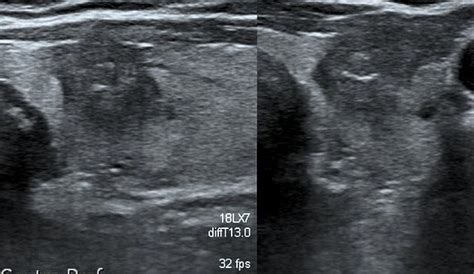 Papillary Thyroid Cancer Echocardiography Or Ultrasound Wikidoc
