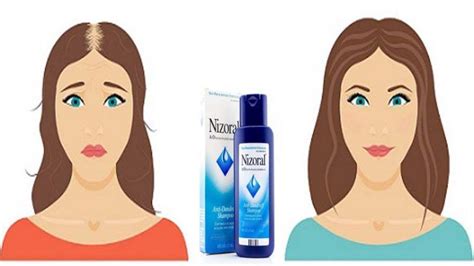 Nizoral Hair Loss Results Renate Mccallum