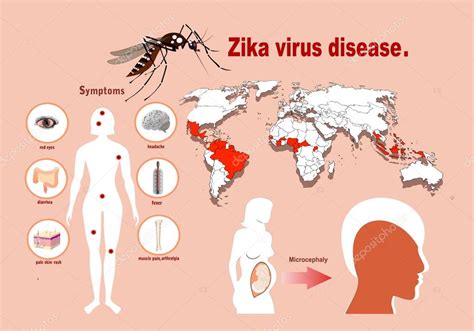 Zika Virus Symptome Infografiken Mit Karte Stockvektor Mitay