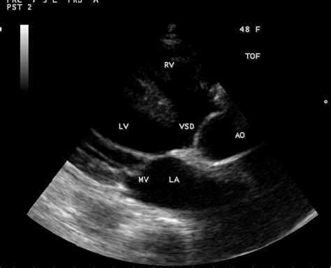 Parasternal Long Axis View Showing The Large Malaligned Ventricular