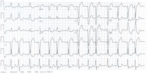 Bundle Branch Block Causes Symptoms Diagnosis And Treatment Natural