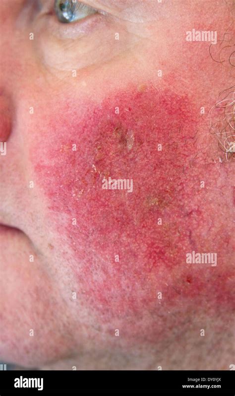 Dark Red Rash Accompanying Benign Skin Cancer After Applying Cream