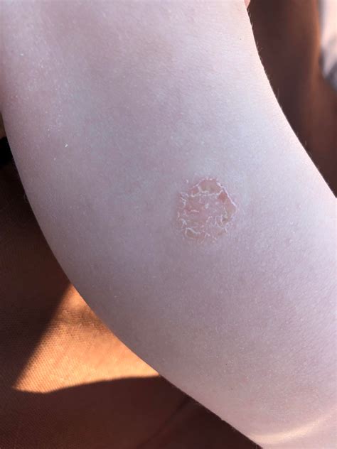Does My Child Have Ringworm Medical