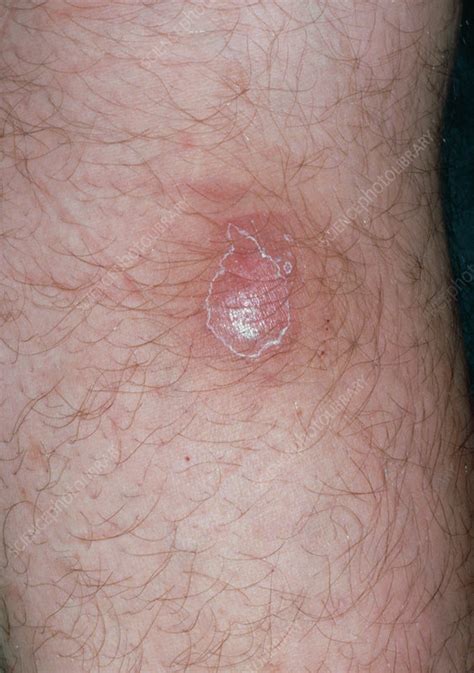 A Skin Boil Containing Pus Stock Image M1200015 Science Photo