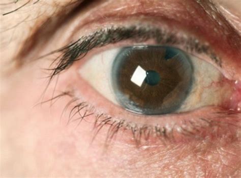 Untreated it can lead to blindness. Can Cannabis Clear Up Glaucoma & Restore Your Sight?