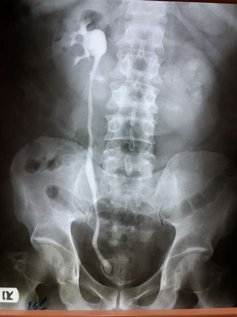 Bilateral Ureteroceles Along With Horseshoe Kidney In An Adult A Case