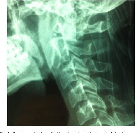 Figure 1 From Atlanto Axial Dislocation Complicating A Type Ii Odontoid