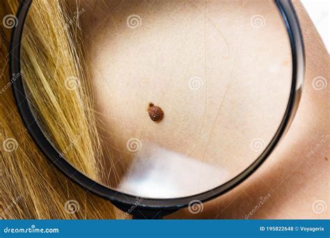 Closeup Brown Mole On Skin Stock Photo Image Of Dermatology 195822648