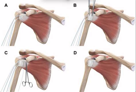 The Biceps Tendon May Help Healing After A Shoulder Replacement