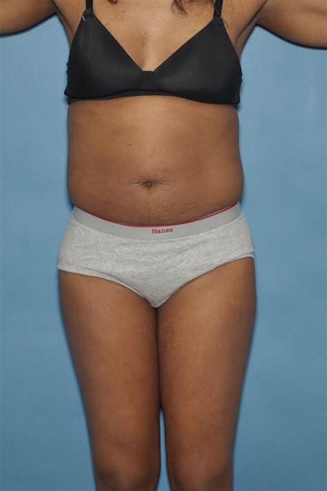 Laser hair removal is the most common and popular hair removal treatment. Gallery - Liliana Laser Clinic | Laser Liposuction, Laser ...
