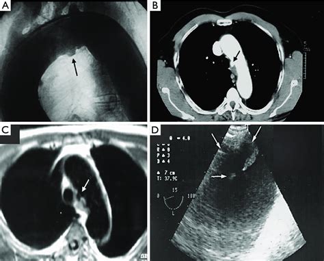 Penetrating Aortic Ulcer Located In The Aortic Arch Arrows Diagnosed