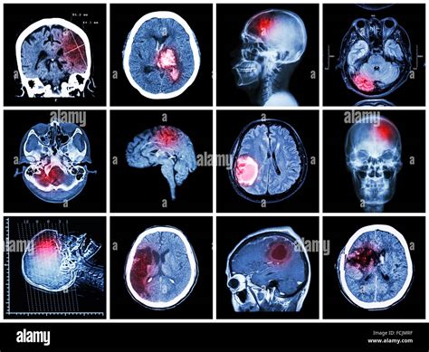 Collection Of Brain Disease Ct Scan And Mri Of Brain Show Cerebral