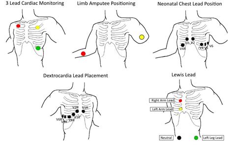 3 Lead Ecg Placement 12 Lead Ecg Placement The Qrs Complex Images And