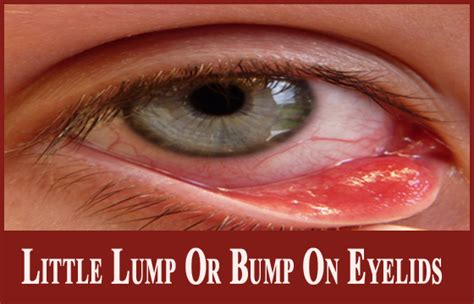 Worried About Little Lump Or Bump On Eyelids Learn Its Causes