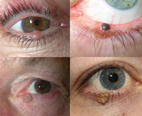 Eyelid Lesions