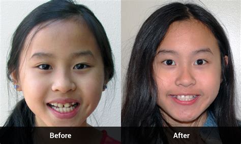 Before And After Photos Of Our Orthodontic Treatment At Portland Braces