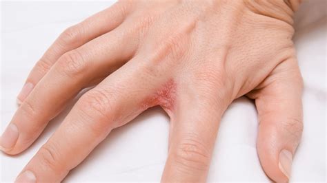 Dyshidrotic Eczema Small Bumps On Hands Causes Treatments Symptoms