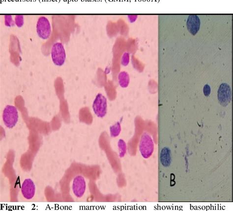 Figure 2 From Acute Basophilic Leukemia A Rare Case Report
