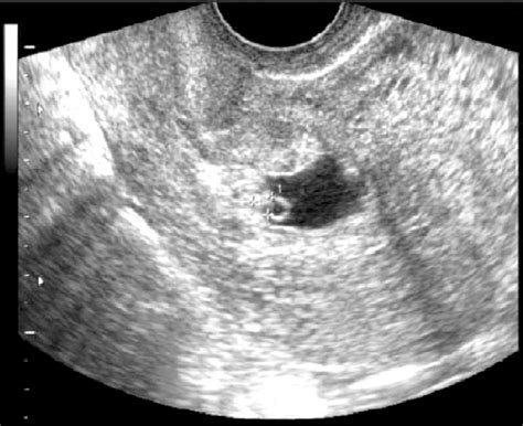 Transvaginal Ultrasound Shows Gestational Sac With A Viable Embryo On Hot Sex Picture