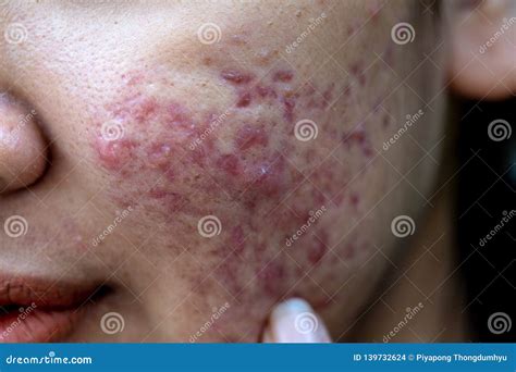 Backgrounds Of Lesions Skin Caused By Acne On The Face Stock Photo