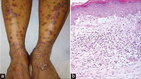 Clinical Demographic And Immunopathological Spectrum Of Subepidermal