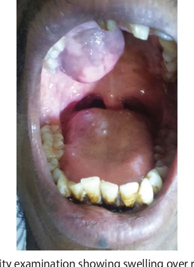 Figure 1 From Pleomorphic Adenoma Of Hard Palate A Case Series