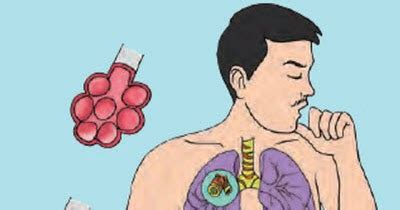 Xerostomia kelainan yang menyebabkan produksi saliva sedikit. Penyakit pada Sistem Pernapasan Manusia - imron.web.id