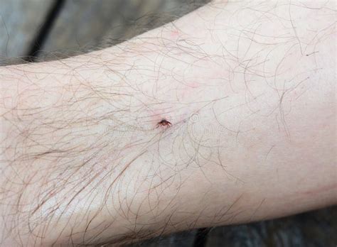 A Man Has A Deer Or Black Legged Tick Bite Ixodes Scapularis Bite On