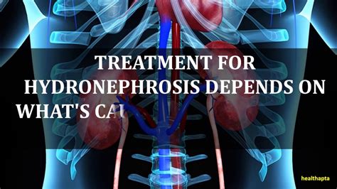 Treatment Of Hydronephrosis Youtube