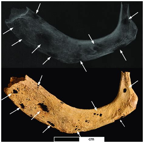 Lytic Lesions In The First Rib Photo And Radiograph Of The Left First