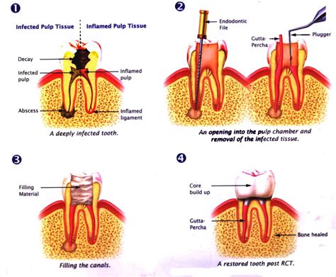 Root Canal Treatment Prestige Dental Care My